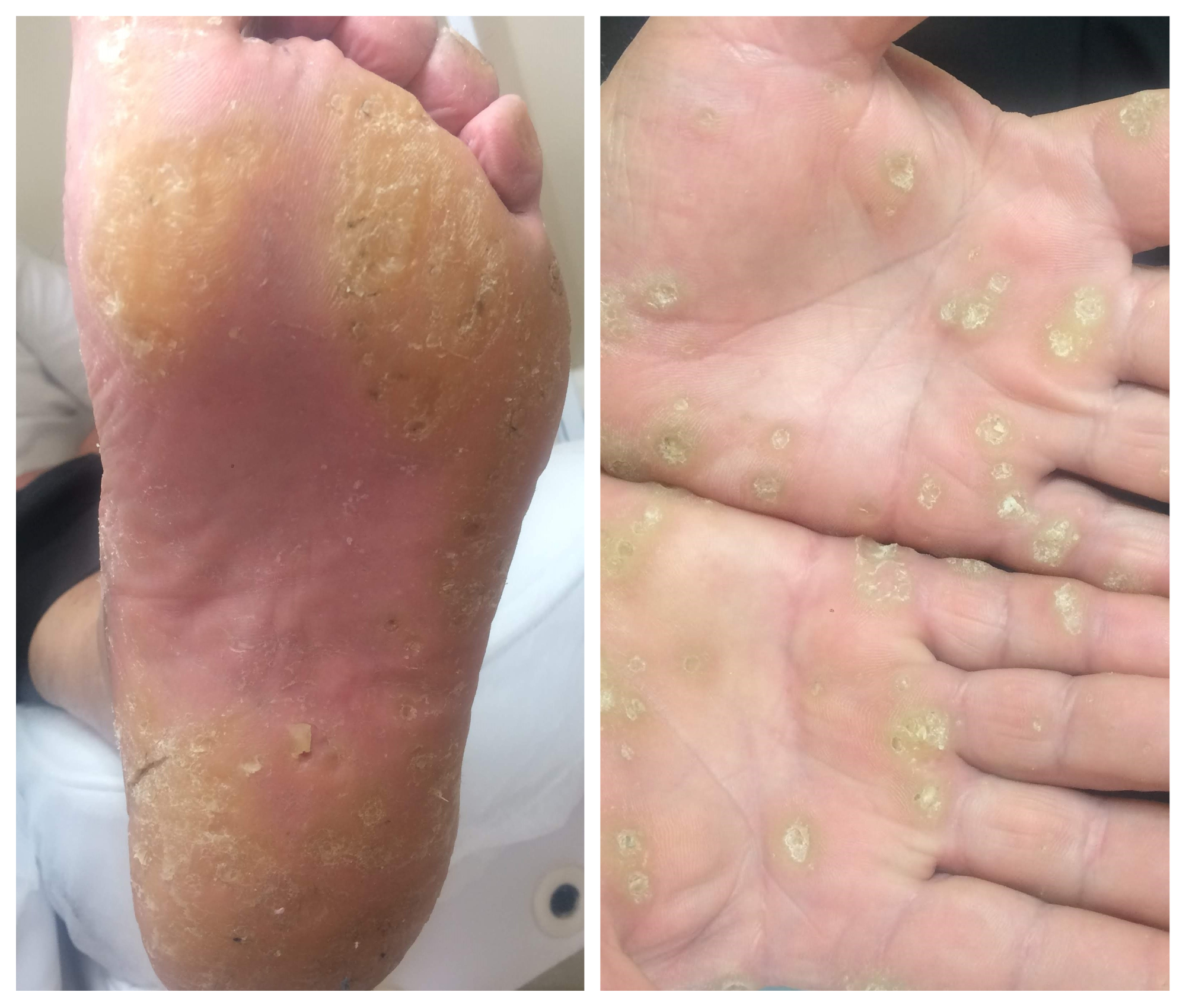 гиперкератоз