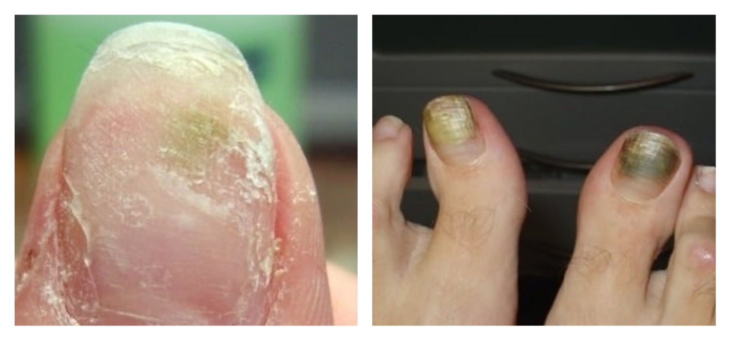 Заболевания ногтевой пластины: как различить плесень и синегнойку? -  pro.bhub.com.ua